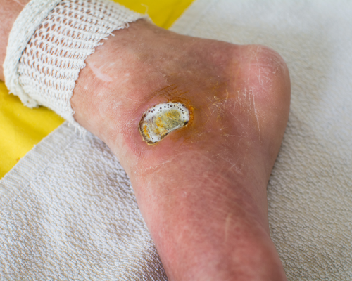Diabetic Foot Ulcer Treatment